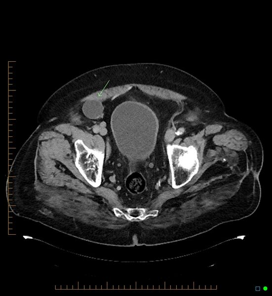 File:Artificial urethral sphincter (Radiopaedia 46937-51464 A 4).jpg