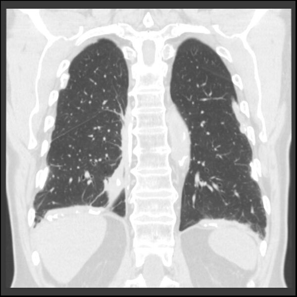 File:Asbestos-related pleural plaques (Radiopaedia 39069-41255 Coronal lung window 22).jpg