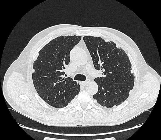 File:Asbestos pleural placques (Radiopaedia 57905-64872 Axial lung window 95).jpg