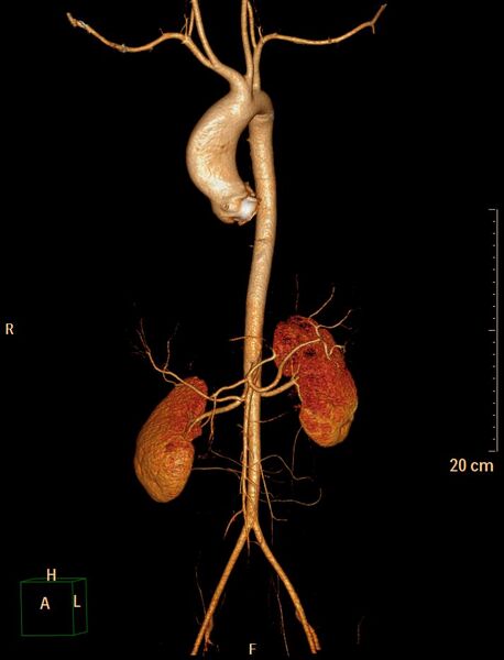 File:Ascending aortic pseudoaneurysm (Radiopaedia 28638-28910 D 33).jpg
