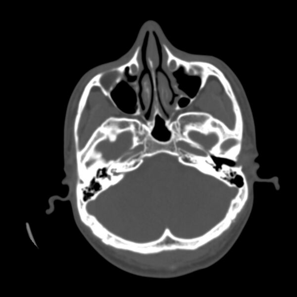 File:Asymptomatic occipital spur (Radiopaedia 87753-104201 Axial bone window 34).jpg