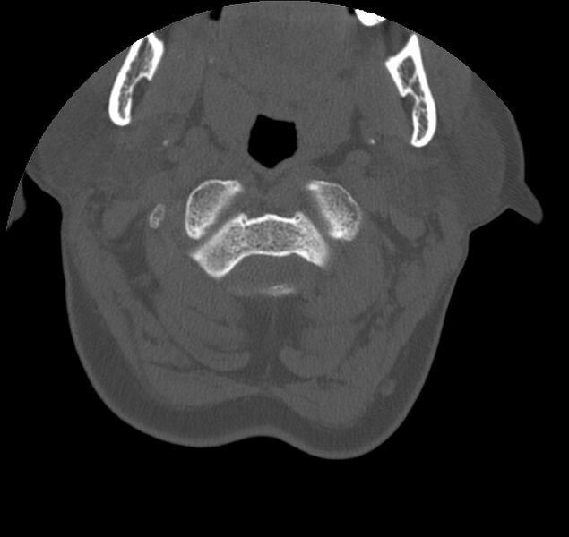 File:Atlanto-occipital assimilation with basilar invagination (Radiopaedia 70122-80188 Axial bone window 29).jpg