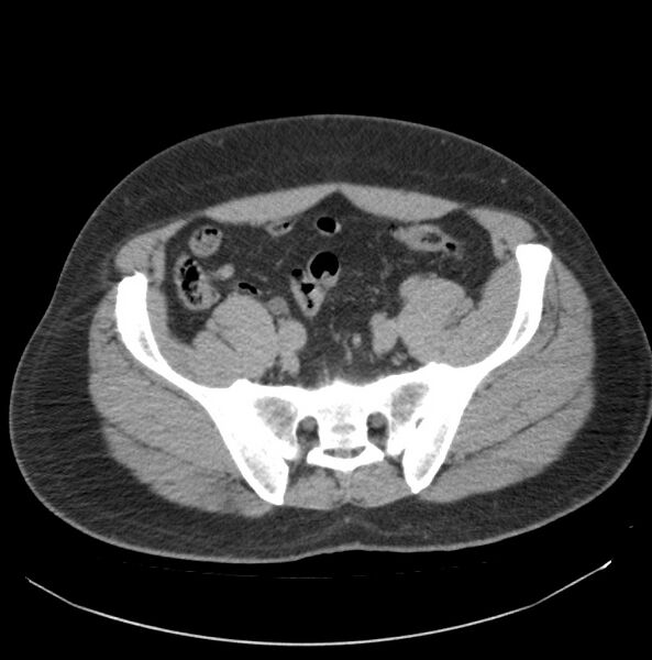 File:Atrophic kidney due to severe chronic obstructive hydronephrosis (Radiopaedia 40828-43474 Axial non-contrast 32).jpg