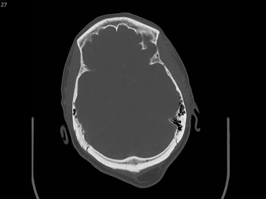 Atypical meningioma - intraosseous (Radiopaedia 64915-73867 Axial C+ bone window 27).jpg