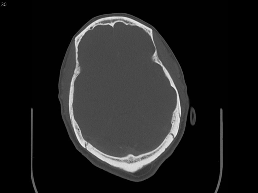 Atypical meningioma - intraosseous (Radiopaedia 64915-73867 Axial C+ bone window 30).jpg
