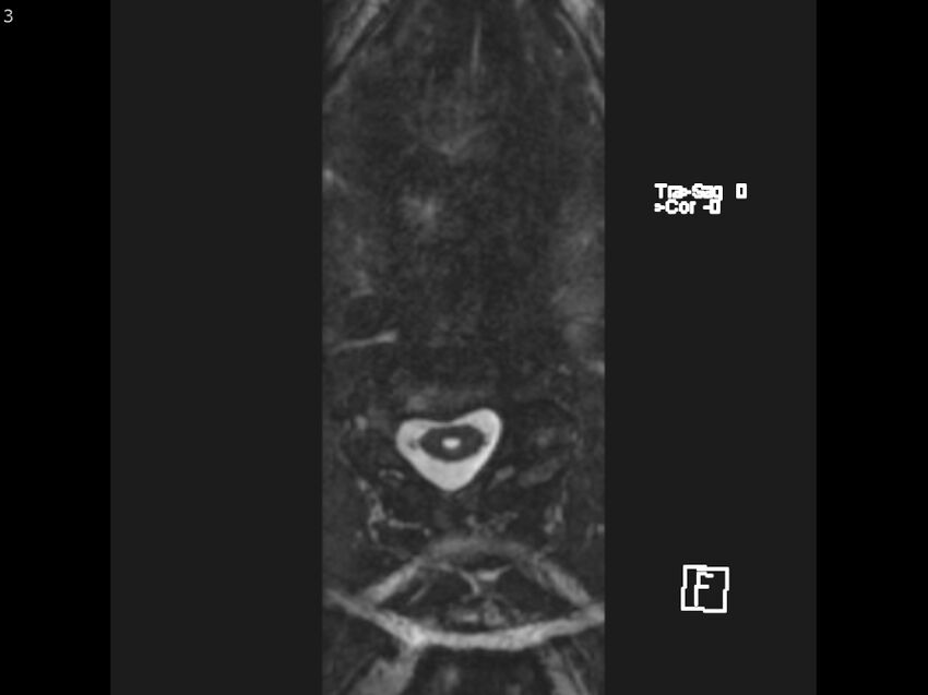 Atypical meningioma - intraosseous (Radiopaedia 64915-74572 Axial CISS 3).jpg