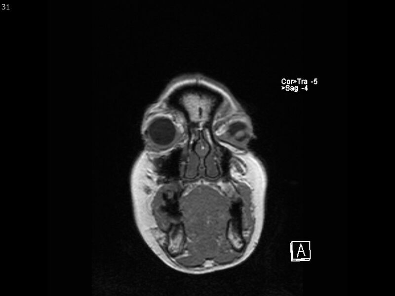 File:Atypical meningioma - intraosseous (Radiopaedia 64915-74572 Coronal T1 31).jpg
