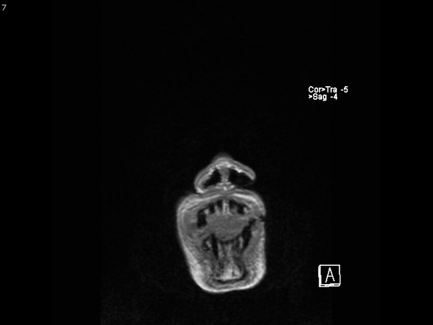 Atypical meningioma - intraosseous (Radiopaedia 64915-74572 Coronal T1 7).jpg
