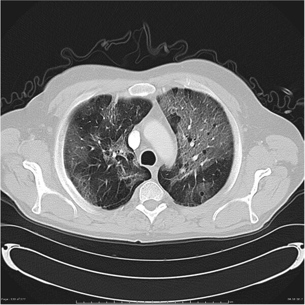 File:Atypical pneumonia - Q fever (Radiopaedia 21993-21989 lung window 9).jpg