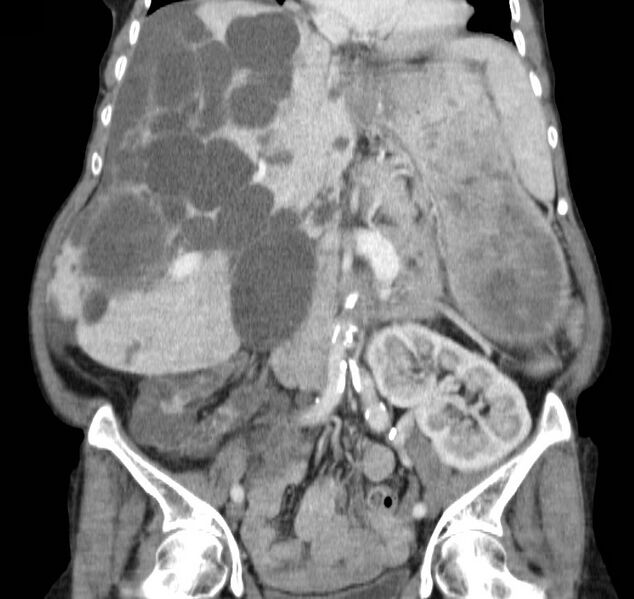 File:Autosomal dominant polycystic kidney disease (Radiopaedia 16777-16490 B 23).jpg