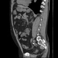 Autosomal dominant polycystic kidney disease (Radiopaedia 36539-38101 D 51).jpg