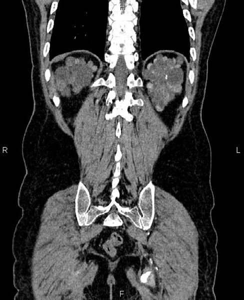 File:Autosomal dominant polycystic kidney disease (Radiopaedia 87830-104287 Coronal non-contrast 56).jpg