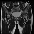 Avascular necrosis of the hip (Radiopaedia 29563-30067 Coronal T2 5).jpg