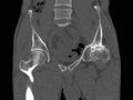 Avascular necrosis of the left hip (Radiopaedia 75068-86125 Coronal bone window 19).jpg