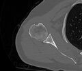 Avulsion fracture - greater tuberosity of humerus (Radiopaedia 71216-81514 Axial bone window 43).jpg