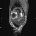 Avulsion fracture of the fibular head (Radiopaedia 74804-85808 Coronal PD fat sat 9).jpg