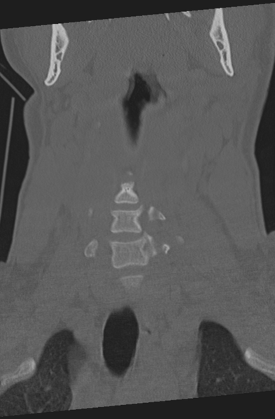 File:Axis peg fracture (type 3) and atlas lateral mass (type 4) fracture (Radiopaedia 37474-39324 Coronal bone window 9).png
