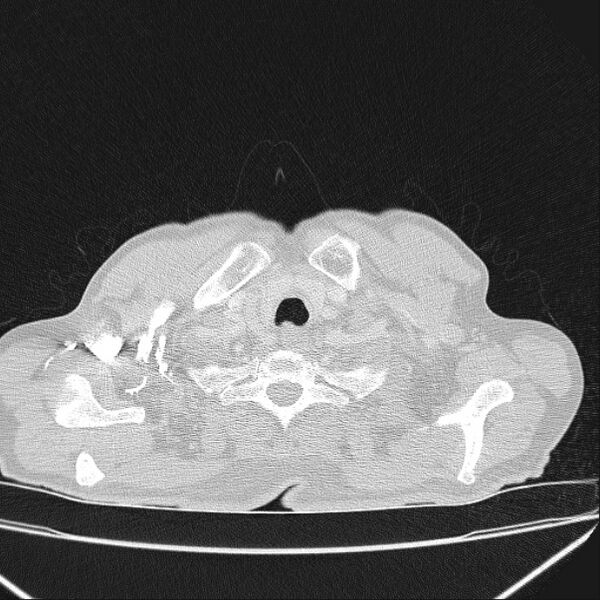 File:Azygos lobe (Radiopaedia 38259-40275 Axial lung window 3).jpg