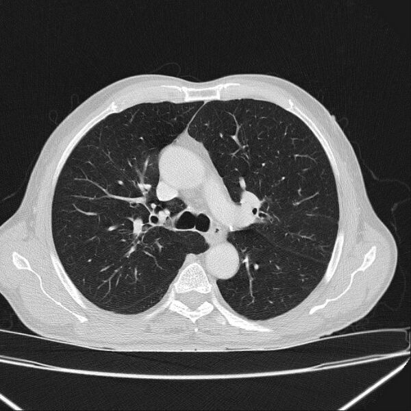 File:Azygos lobe (Radiopaedia 38259-40275 Axial lung window 31).jpg
