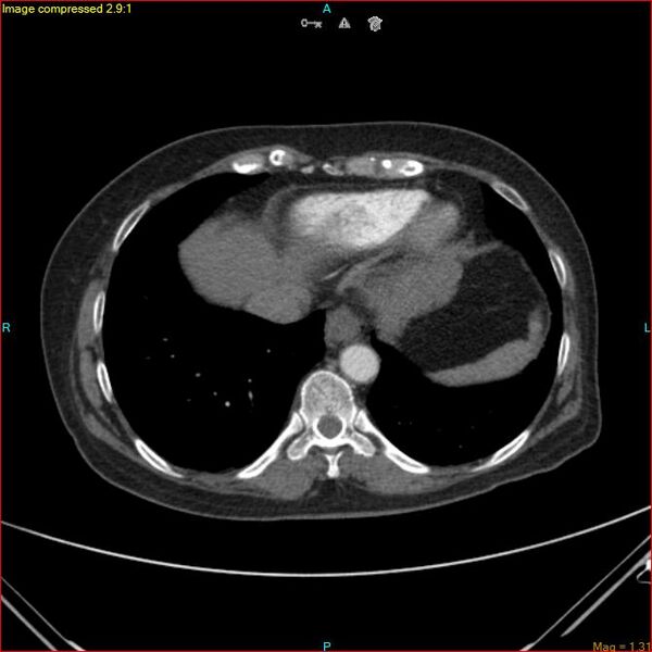 File:Azygos vein aneurysm (Radiopaedia 77824-90130 B 43).jpg
