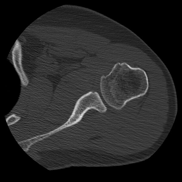 File:Bankart lesion (Radiopaedia 22771-22798 Axial bone window 24).jpg