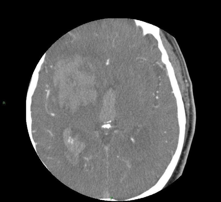 Basal ganglia hemorrhage (Radiopaedia 58763-65985 D 95).jpg