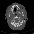Base of skull fracture with bilateral Le Fort fractures (Radiopaedia 47094-51638 Axial bone window 16).jpg
