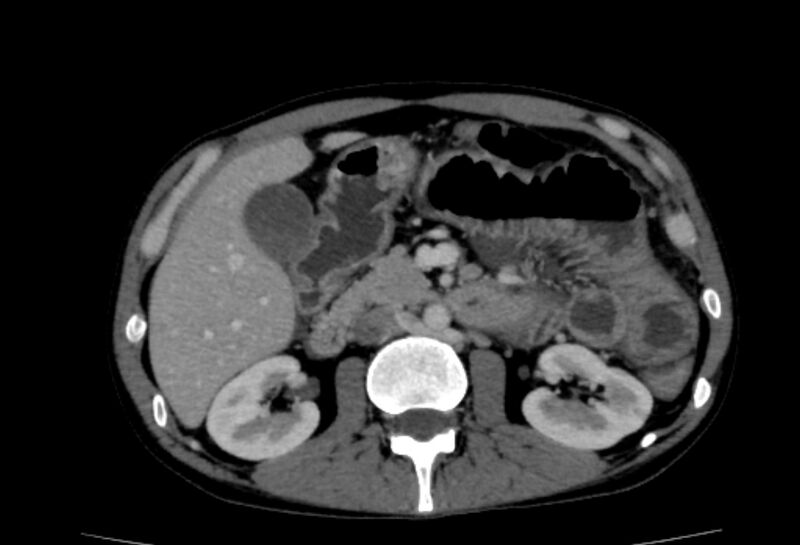 File:Behçet's disease- abdominal vasculitis (Radiopaedia 55955-62570 A 30).jpg