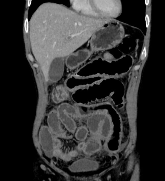 File:Behçet's disease- abdominal vasculitis (Radiopaedia 55955-62570 B 11).jpg