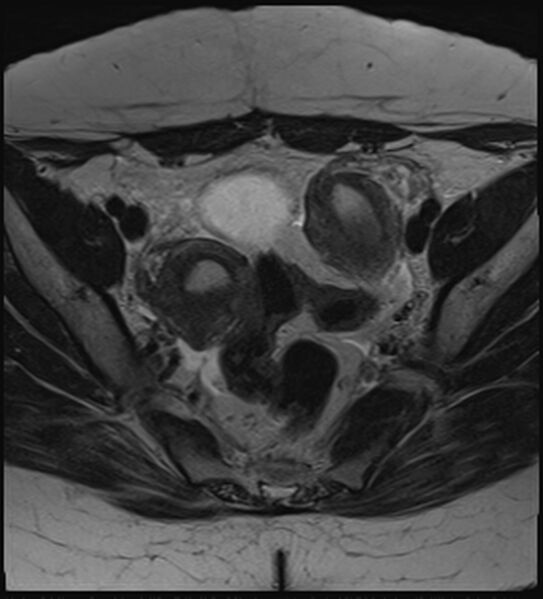 File:Bicornuate, unicollis uterus (Radiopaedia 79468-92593 Axial T2 8).jpg