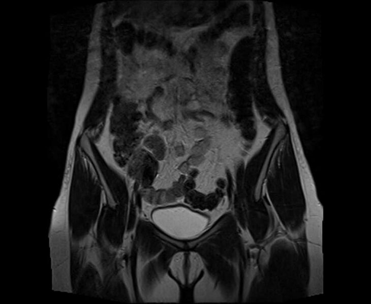 File:Bicornuate bicollis uterus (Radiopaedia 61626-69616 Coronal T2 9).jpg