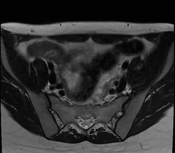 File:Bicornuate uterus (Radiopaedia 71214-81511 Axial T2 26).jpg