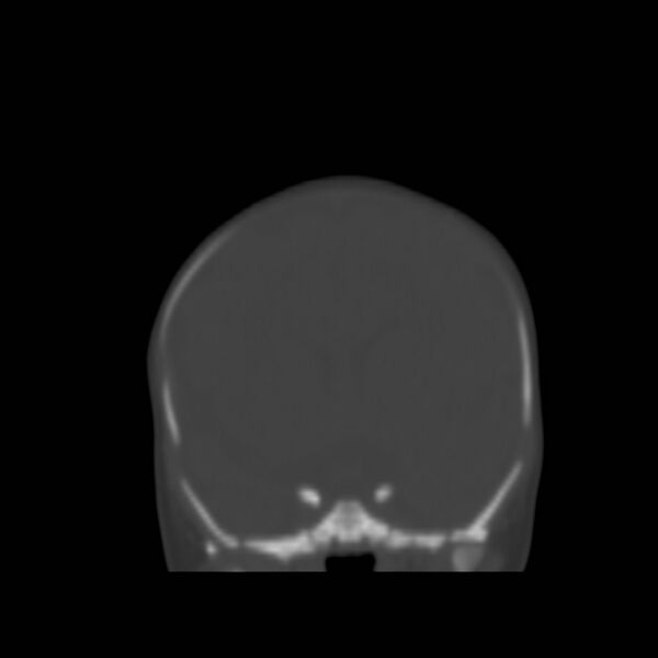 File:Bilateral cephalohematomas and subdural hematomas (Radiopaedia 26778-26929 Coronal bone window 7).jpg