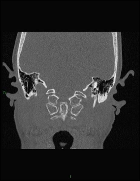 File:Bilateral frontal mucoceles (Radiopaedia 82352-96454 Coronal 328).jpg