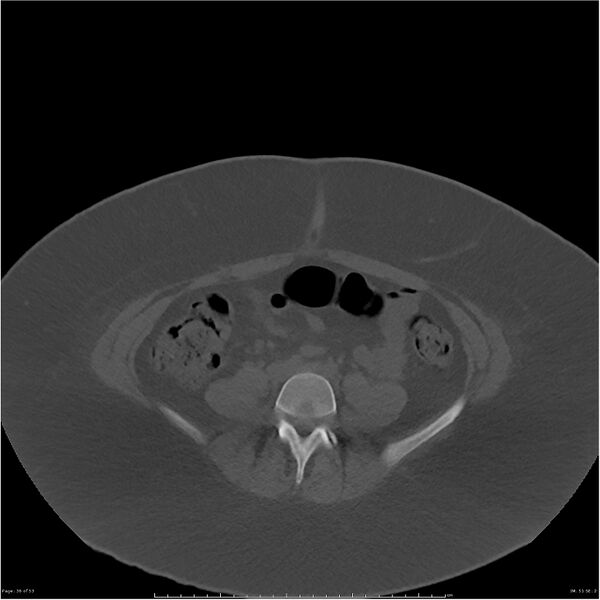 File:Bilateral lumbar ribs (Radiopaedia 25862-26010 bone window 36).jpg