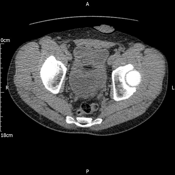 File:Bilateral medullary nephrocalcinosis with ureteric calculi (Radiopaedia 71269-81569 Axial non-contrast 119).jpg