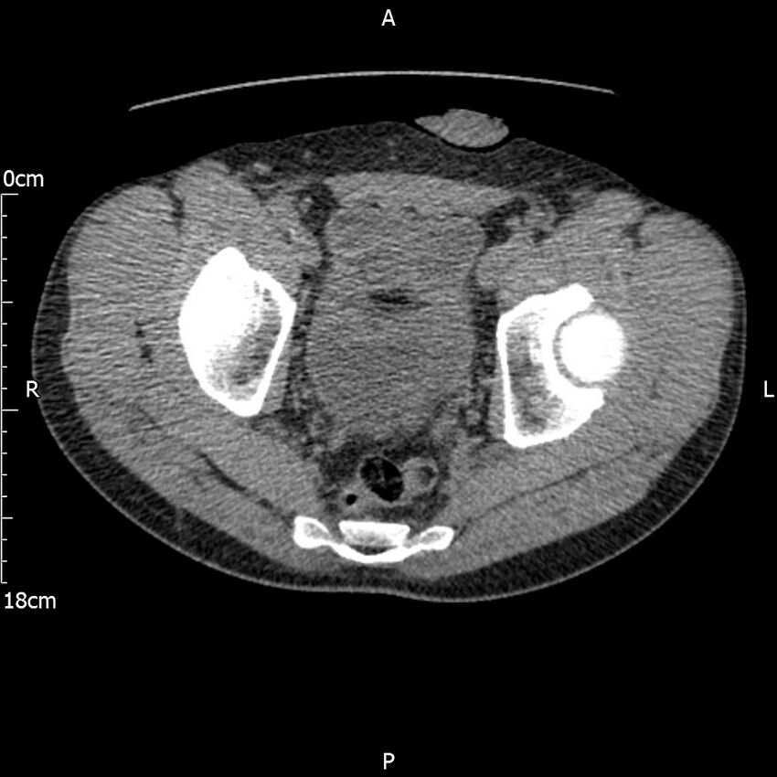Bilateral medullary nephrocalcinosis with ureteric calculi (Radiopaedia 71269-81569 Axial non-contrast 119).jpg