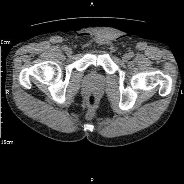 File:Bilateral medullary nephrocalcinosis with ureteric calculi (Radiopaedia 71269-81569 Axial non-contrast 133).jpg