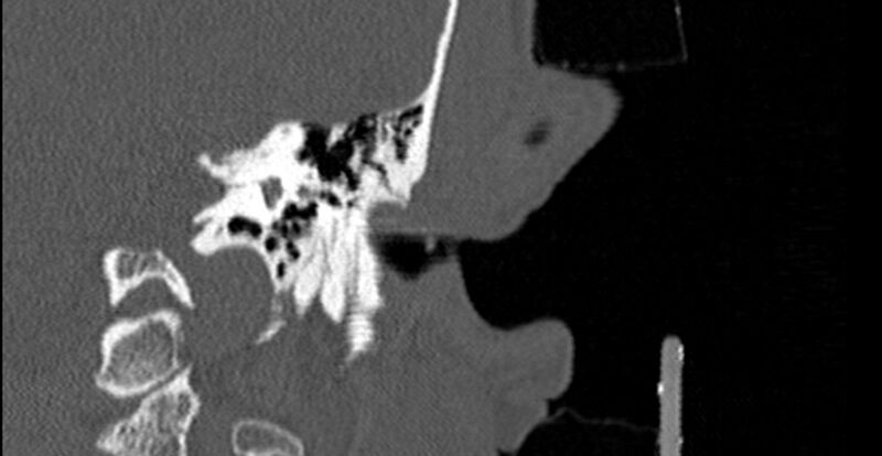 File:Bilateral temporal bone fractures (Radiopaedia 29482-29970 B 45).jpg