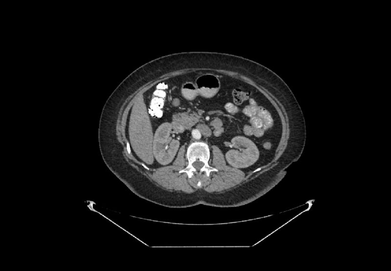 File:Bilateral urolithiasis with incidentally detected splenic artery aneurysm and left inferior vena cava (Radiopaedia 44467-48127 A 43).jpg