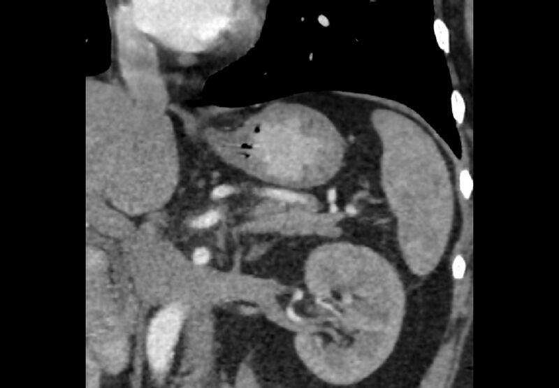 File:Bilateral urolithiasis with incidentally detected splenic artery aneurysm and left inferior vena cava (Radiopaedia 44467-48127 Ob. Cor. C+ Art. 21).jpg