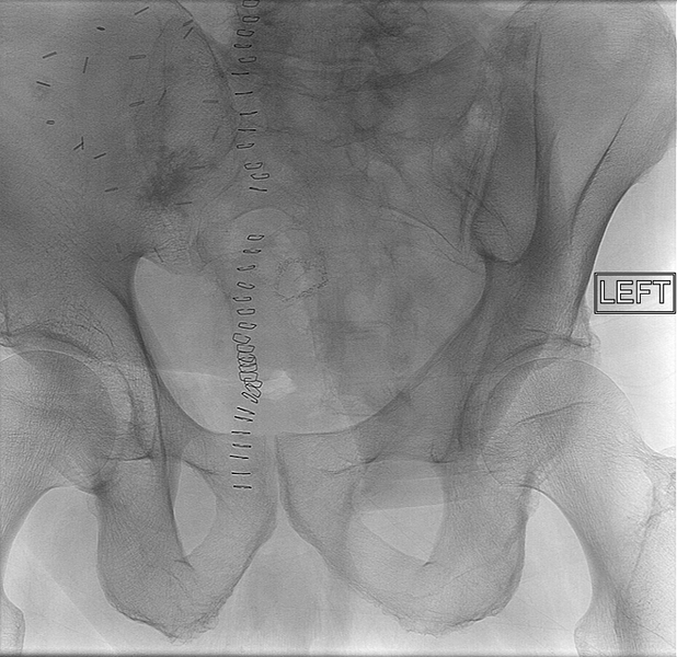 File:Bladder leak post partial cystectomy (Radiopaedia 29744-30264 control 1).png