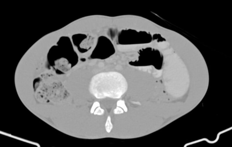 File:Blunt injury to the small bowel (Radiopaedia 74953-85987 Axial Wide 56).jpg