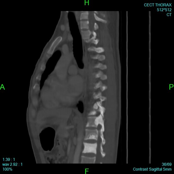 File:Bone metastases from lung carcinoma (Radiopaedia 54703-60937 Sagittal bone window 36).jpg
