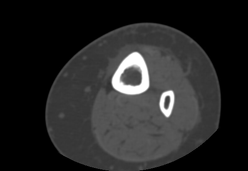 File:Bone metastasis - tibia (Radiopaedia 57665-64609 Axial bone window 5).jpg