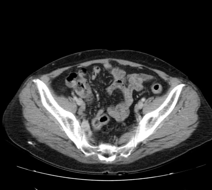 Bosniak renal cyst - type IV (Radiopaedia 22929-22953 C 54).jpg