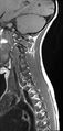 Brachial plexus birth palsy (Radiopaedia 68118-77604 Sagittal T1 10).jpg