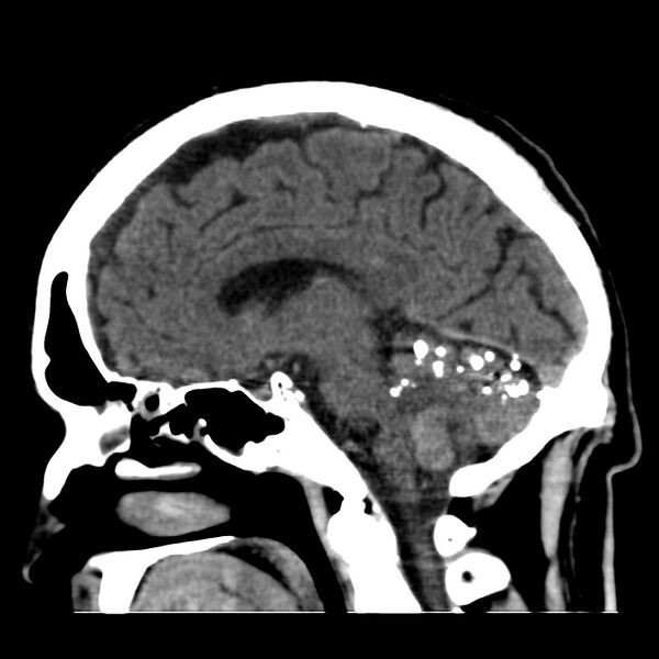 File:Brain Pantopaque remnants (Radiopaedia 78403-91048 C 32).jpg
