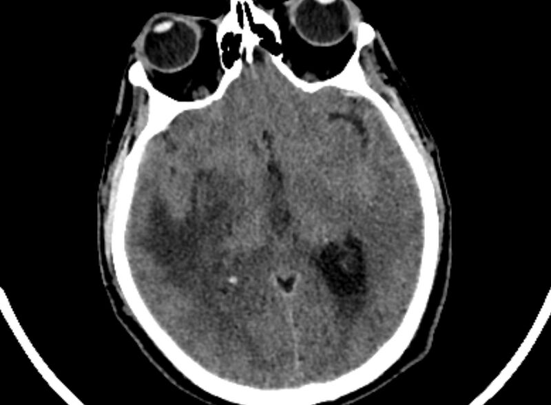 File:Brain abscess complicated by intraventricular rupture and ventriculitis (Radiopaedia 82434-96575 Axial non-contrast 35).jpg