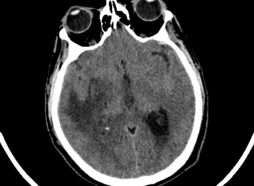 Brain abscess complicated by intraventricular rupture and ventriculitis (Radiopaedia 82434-96575 Axial non-contrast 35).jpg